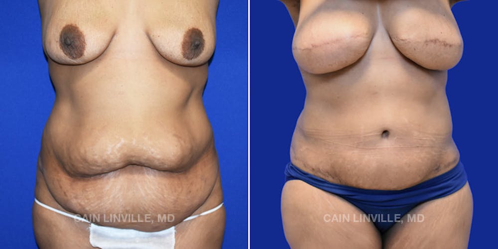 Breast Reconstruction  Before & After Gallery - Patient 48689535 - Image 4