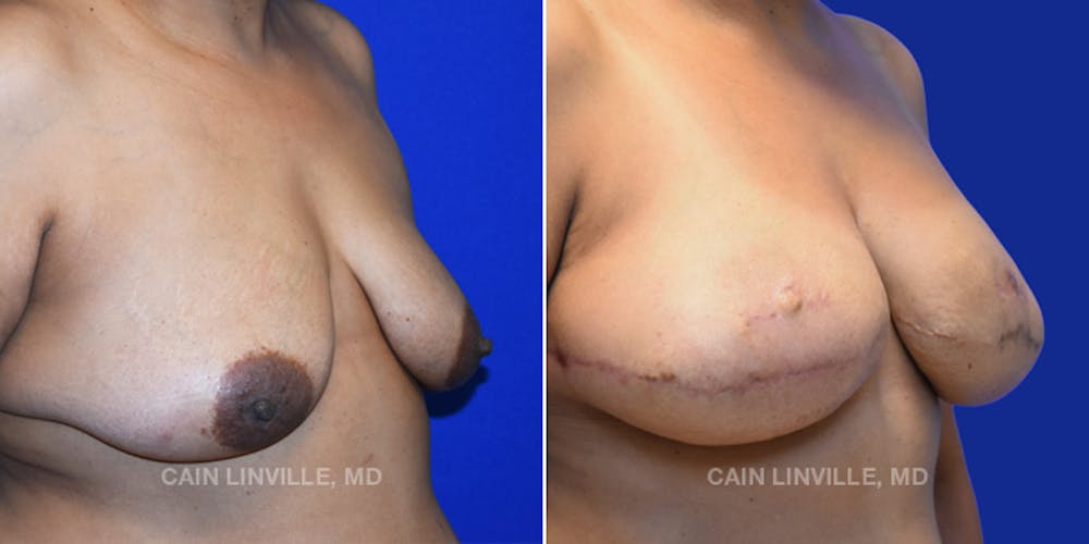 Breast Reconstruction  Before & After Gallery - Patient 48689535 - Image 5