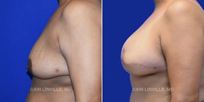 Breast Reconstruction  Before & After Gallery - Patient 48689535 - Image 6