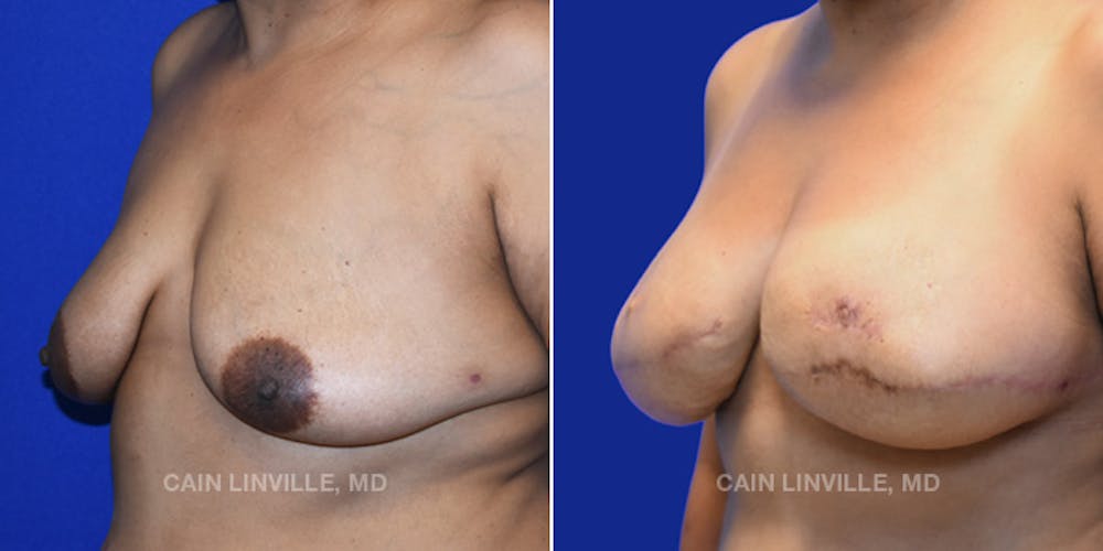 Breast Reconstruction  Before & After Gallery - Patient 48689535 - Image 7