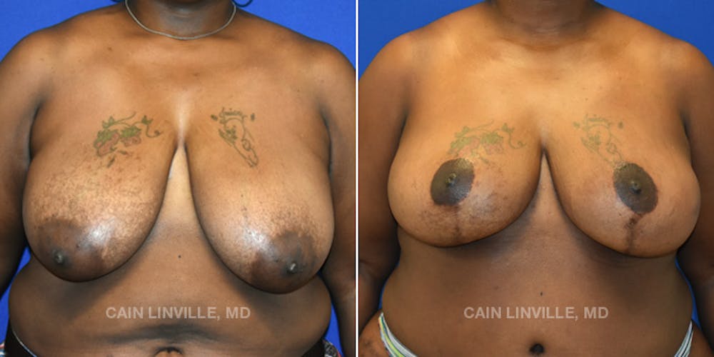 Breast Reconstruction  Before & After Gallery - Patient 48689601 - Image 1