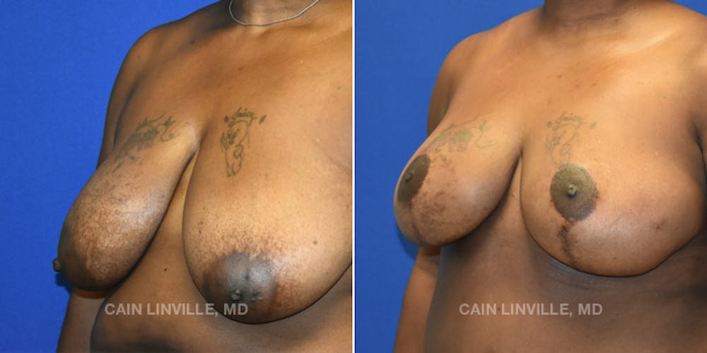 Breast Reconstruction  Before & After Gallery - Patient 48689601 - Image 2