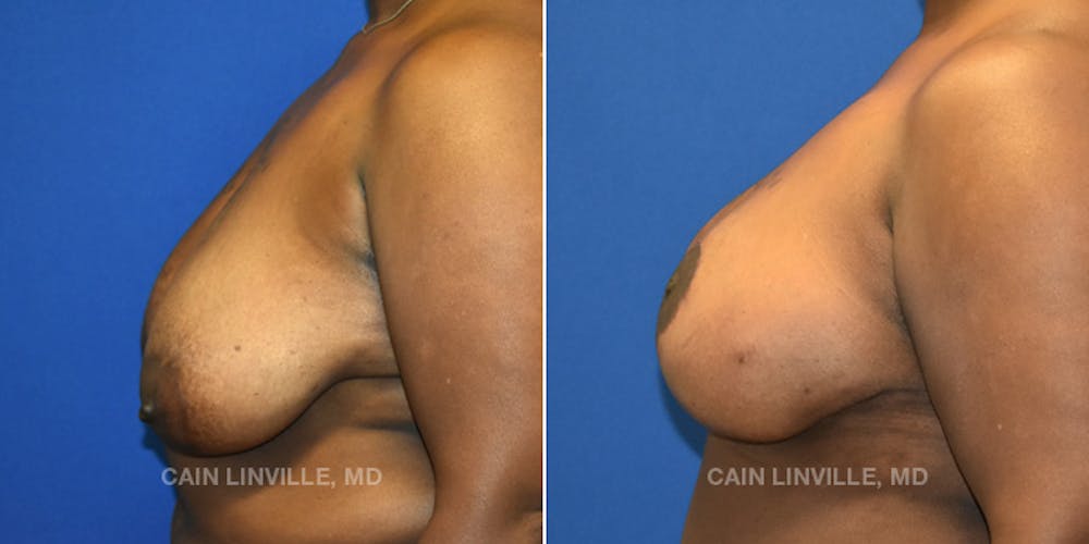 Breast Reconstruction  Before & After Gallery - Patient 48689601 - Image 3