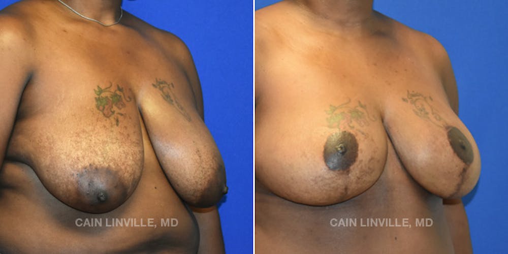Breast Reconstruction  Before & After Gallery - Patient 48689601 - Image 4