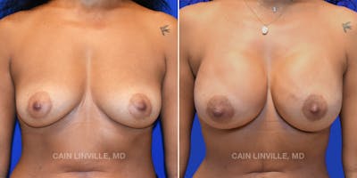 Breast Reconstruction  Before & After Gallery - Patient 48689602 - Image 1