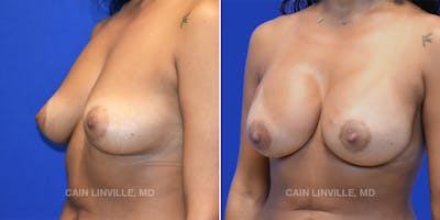 Breast Reconstruction  Before & After Gallery - Patient 48689602 - Image 2