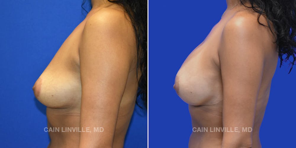 Breast Reconstruction  Before & After Gallery - Patient 48689602 - Image 3