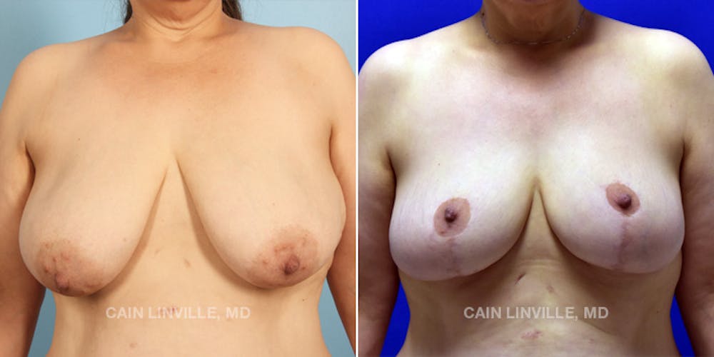 Breast Reduction Before & After Gallery - Patient 48689744 - Image 1