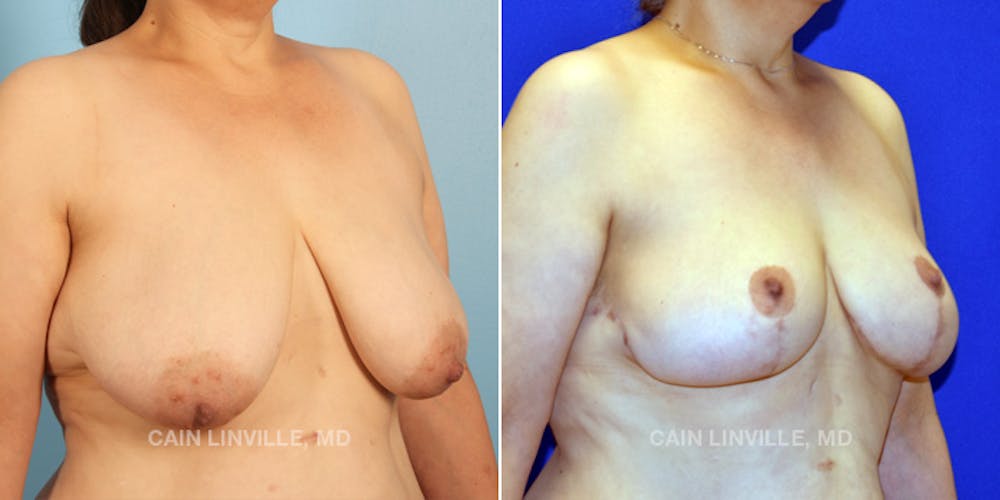 Breast Lift Before & After Gallery - Patient 119935752 - Image 3