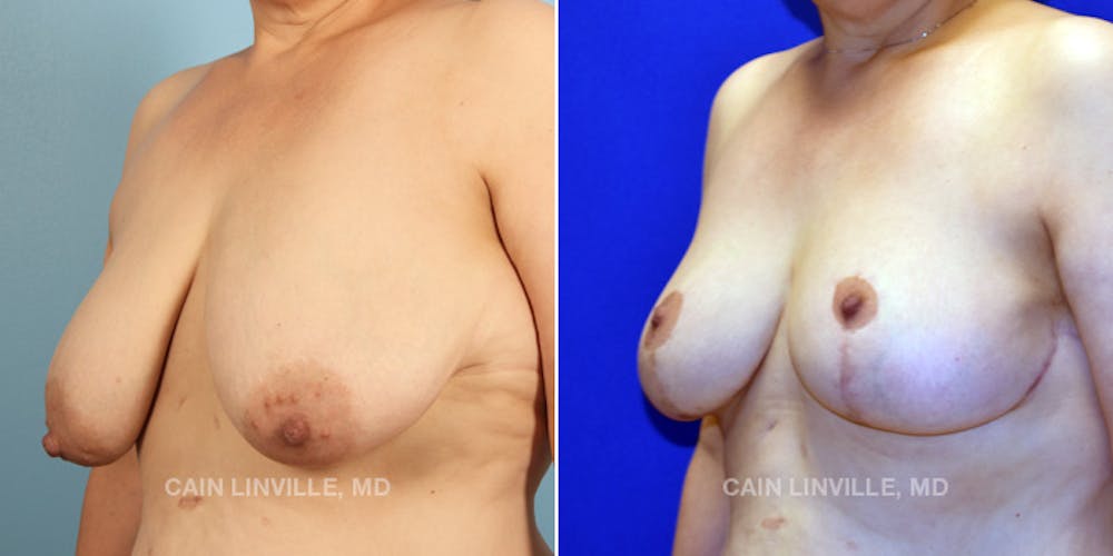 Breast Reduction Before & After Gallery - Patient 48689744 - Image 3