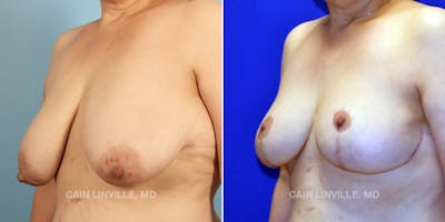 Breast Lift Before & After Gallery - Patient 119935752 - Image 2