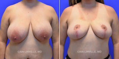 Breast Lift Before & After Gallery - Patient 119939975 - Image 1