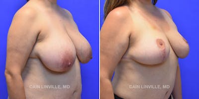 Breast Lift Before & After Gallery - Patient 119939975 - Image 4