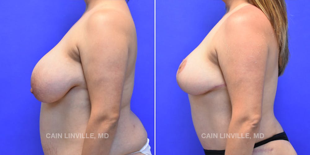 Breast Lift Before & After Gallery - Patient 119939975 - Image 3