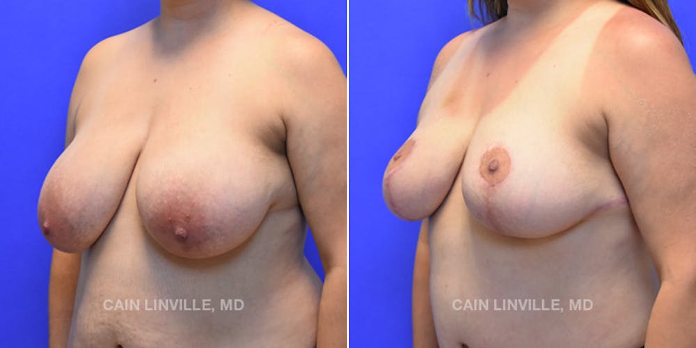 Breast Reduction Before & After Gallery - Patient 48689745 - Image 5
