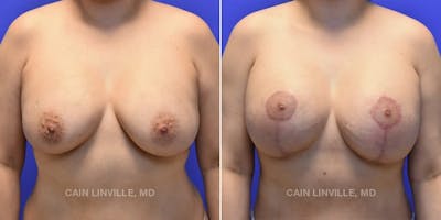 Breast Revision Before & After Gallery - Patient 48689808 - Image 1