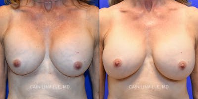 Breast Revision Before & After Gallery - Patient 48689809 - Image 1