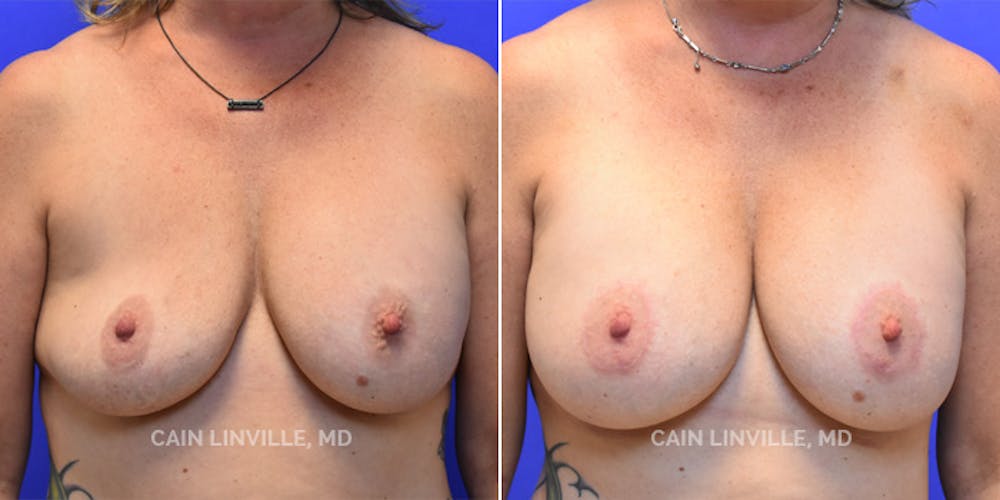 Breast Revision Before & After Gallery - Patient 48689810 - Image 1