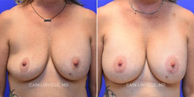 Breast Revision Gallery - Patient 48689810 - Image 1