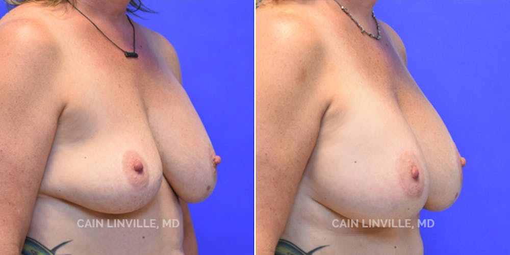 Breast Revision Before & After Gallery - Patient 48689810 - Image 4