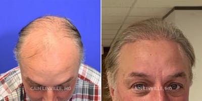 Hair Restoration  Before & After Gallery - Patient 144658912 - Image 1