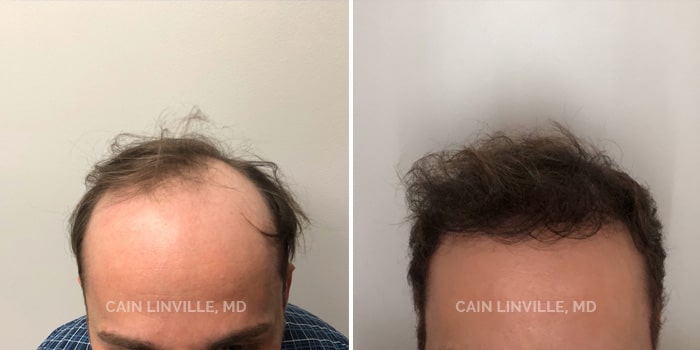 NeoGraft Austin | FUE Hair Transplant Austin NeoGraft Austin | FUE Hair Transplant Austin