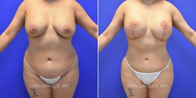 Mommy Makeover Before & After Gallery - Patient 48693971 - Image 1