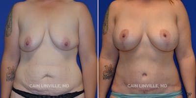 Mommy Makeover Before & After Gallery - Patient 48693972 - Image 1