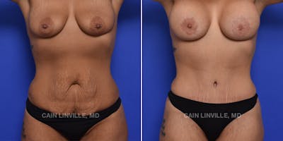 Mommy Makeover Before & After Gallery - Patient 48693973 - Image 1