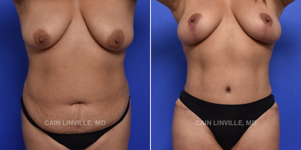 Tummy Tuck (Abdominoplasty) Before & After Gallery - Patient 119940298 - Image 1