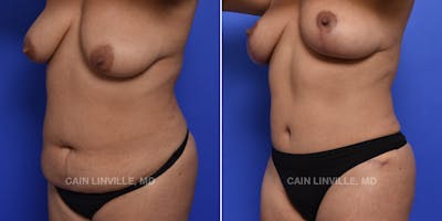 Tummy Tuck (Abdominoplasty) Before & After Gallery - Patient 119940298 - Image 2