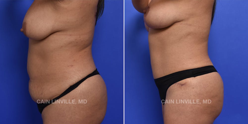 Tummy Tuck (Abdominoplasty) Before & After Gallery - Patient 119940298 - Image 3