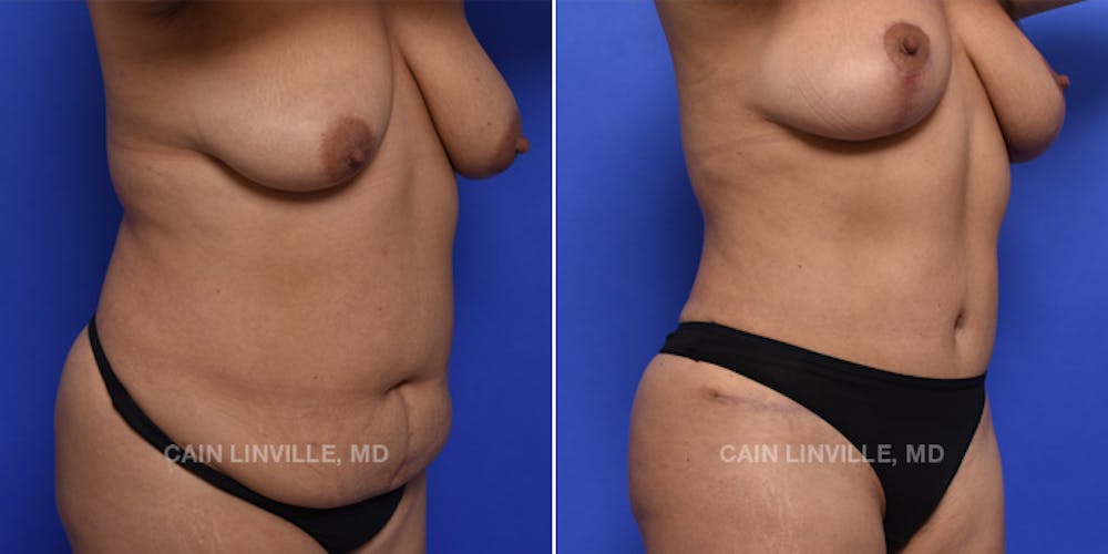 Tummy Tuck (Abdominoplasty) Before & After Gallery - Patient 119940298 - Image 4