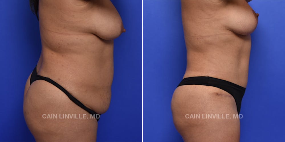 Tummy Tuck (Abdominoplasty) Before & After Gallery - Patient 119940298 - Image 5