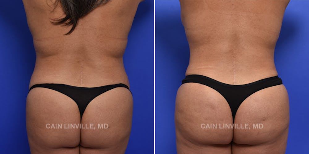 Patient 119942195, Brazilian Butt Lift (BBL) Before & After Photos