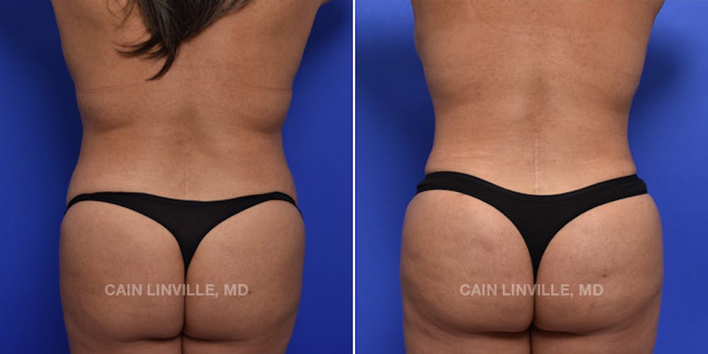 Patient 119942195  Brazilian Butt Lift (BBL) Before & After