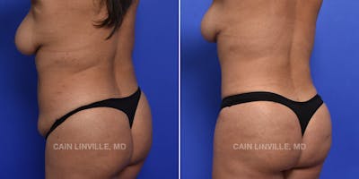 Brazilian Butt Lift (BBL) Before & After Gallery - Patient 119942195 - Image 2