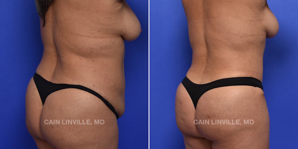Brazilian Butt Lift (BBL) Before & After Gallery - Patient 48693978 - Image 3