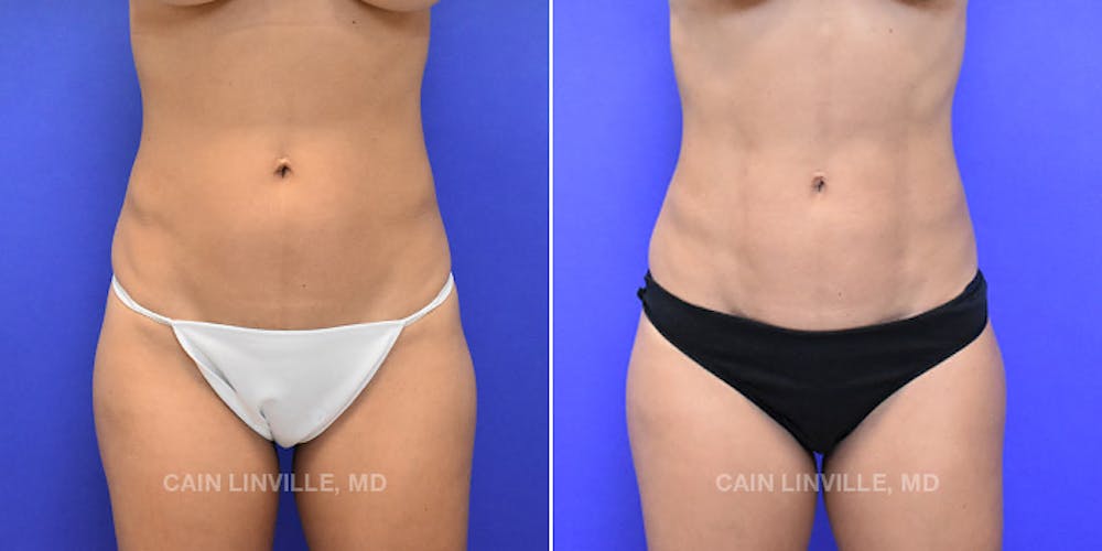 Body Etching (High-Def Lipo) Before & After Gallery - Patient 48694006 - Image 1
