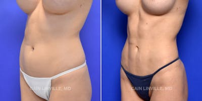 Body Etching (High-Def Lipo) Before & After Gallery - Patient 48694007 - Image 2