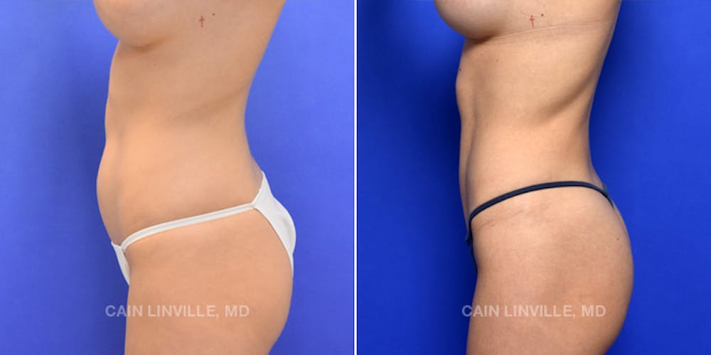 Body Etching (High-Def Lipo) Before & After Gallery - Patient 48694007 - Image 3