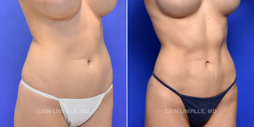 Patient 48694007, Body Etching (High-Def Lipo) Before & After Photos