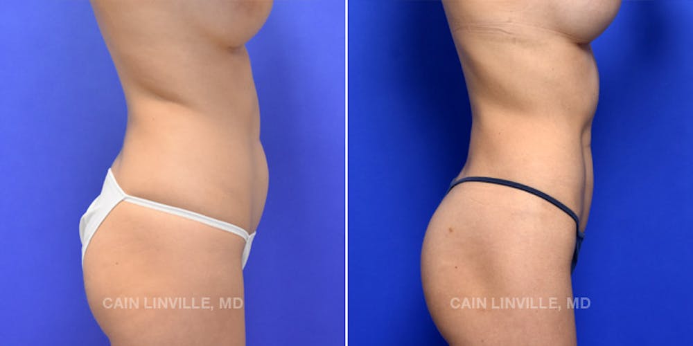 Body Etching (High-Def Lipo) Before & After Gallery - Patient 48694007 - Image 5