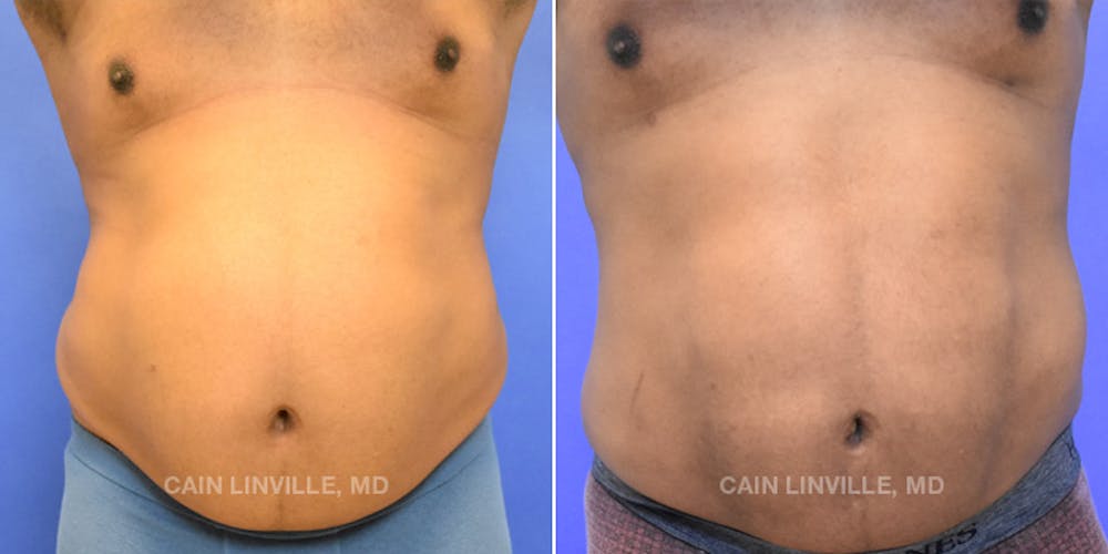 Body Etching (High-Def Lipo) Before & After Gallery - Patient 48694008 - Image 1