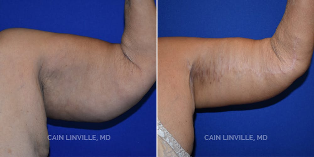 Arm Lift Before & After Gallery - Patient 8522137 - Image 2