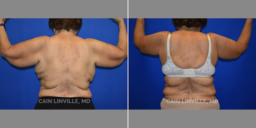 Arm Lift Before & After Gallery - Patient 8522137 - Image 3