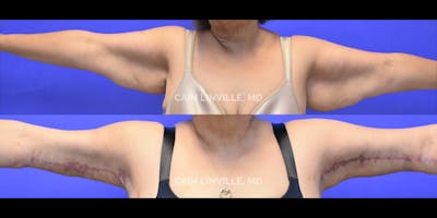 Arm Lift Before & After Gallery - Patient 48694018 - Image 1