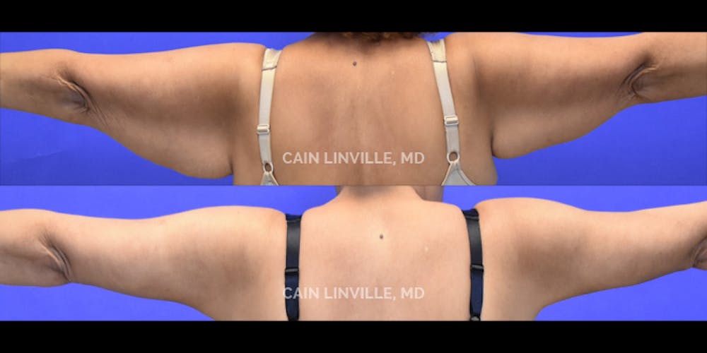 Arm Lift Before & After Gallery - Patient 48694018 - Image 2