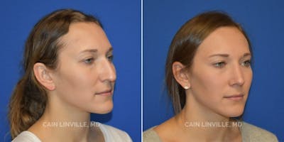 Rhinoplasty Before & After Gallery - Patient 48694025 - Image 2