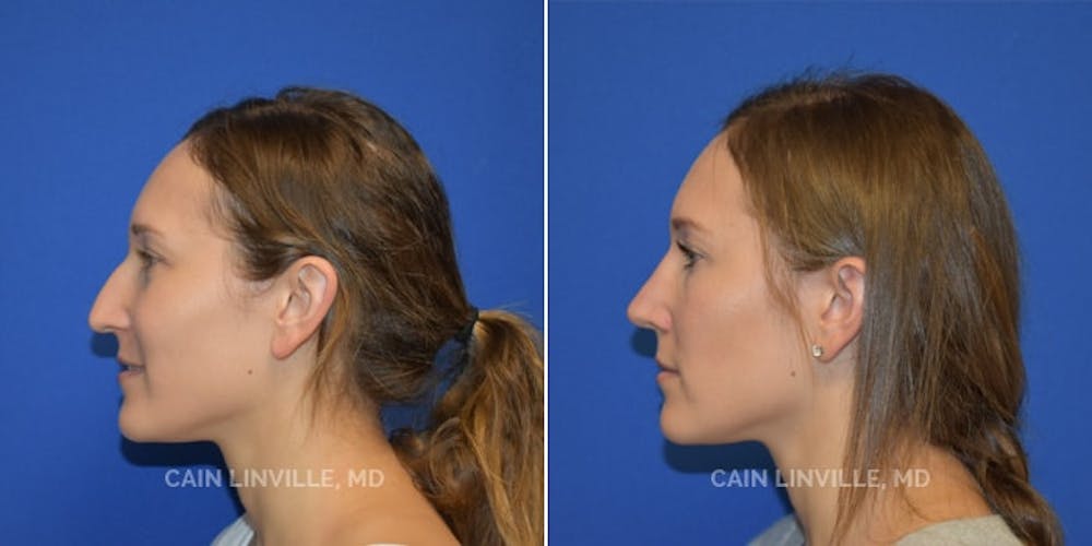 Rhinoplasty Before & After Gallery - Patient 48694025 - Image 3
